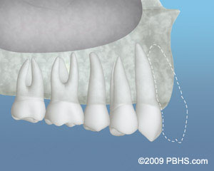 Inadequate Bone for dental implant