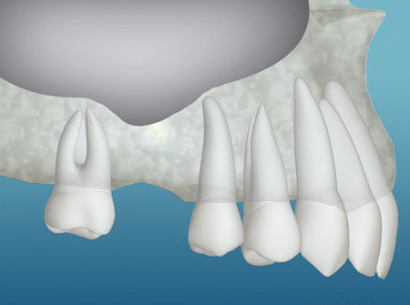 Inadequate Bone for dental implant