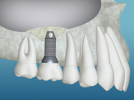 Bone Graft Material and Dental Implant Placed