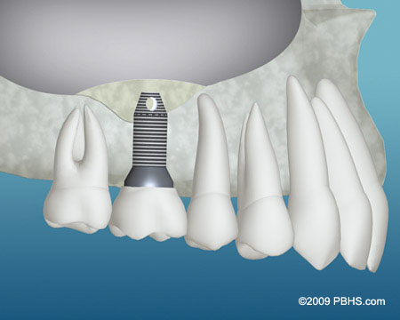 Bone Graft Material and Dental Implant Placed