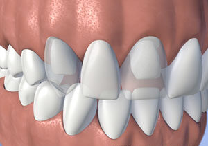 Fixed Bridge, dental bridge
