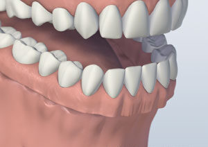 Denture