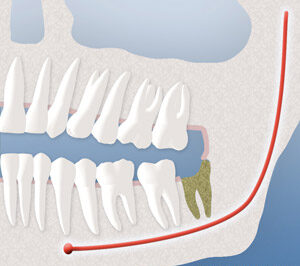 Dry sockets