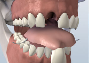 Flipper, removable plastic retainer