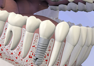 Dental Implants