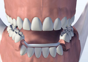 Metal Partial, removable partial denture