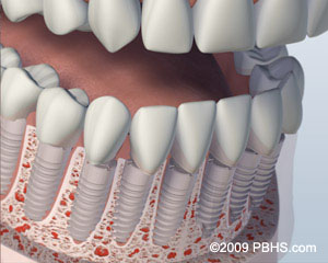 After Dental Implants Placed