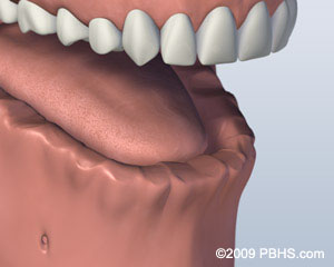 Before Bar Attachment Denture