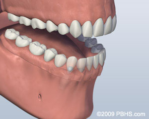 Denture Attached