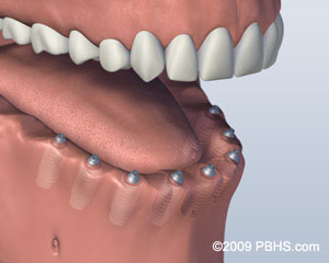 After Dental Implants Placed