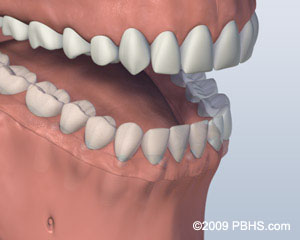 Denture Attached