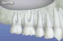 sinus lift