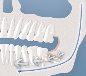 An illustration of teeth crowding causes by a wisdom tooth