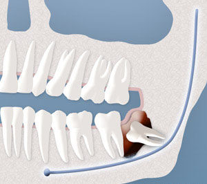 An example of a cyst formation on a wisdom tooth