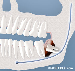 An example of a cyst formation on a wisdom tooth