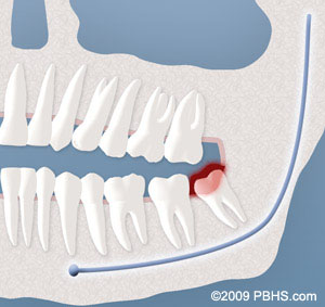 A representation of a pericoronitis infection on a wisdom tooth