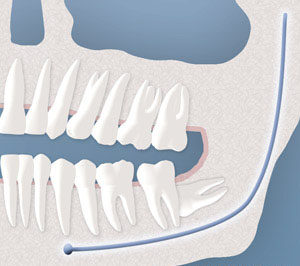 An illustration of a tooth completely impacted by bone