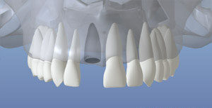 After Tooth Loss