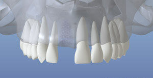 Healed Bone, after bone grafting