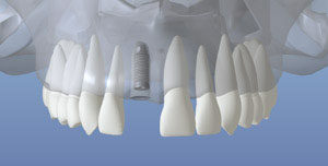 Dental Implant Placed
