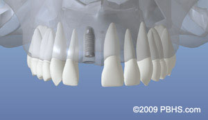 Dental Implant Placed