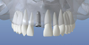 Healing after dental implant placement
