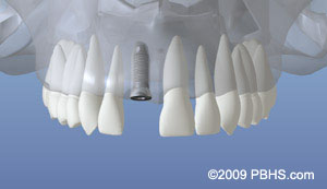 Healing after dental implant placement