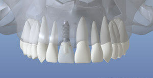 Dental Implant Restored