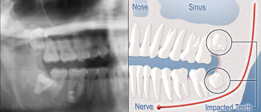 A diagram half mouth X-ray with teeth impaction and half digital graphic highlighting impacted teeth