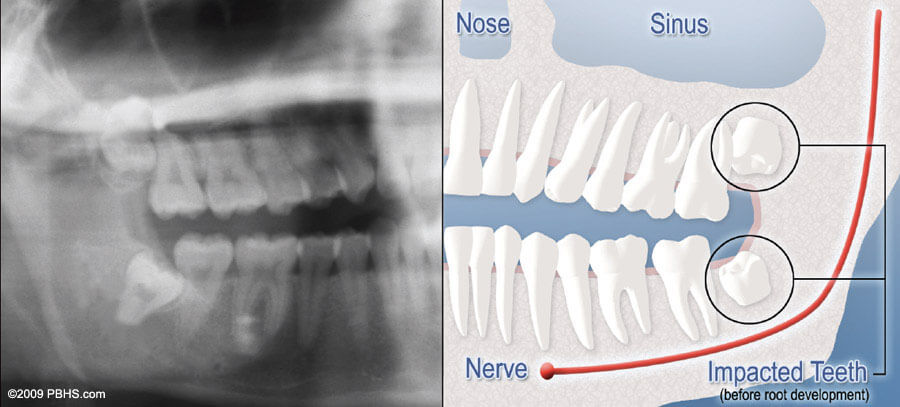 A diagram half mouth X-ray with teeth impaction and half digital graphic highlighting impacted teeth