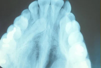 impacted tooth