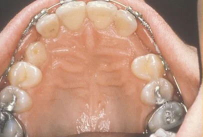 impacted tooth