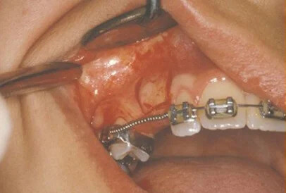 impacted tooth