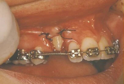impacted tooth