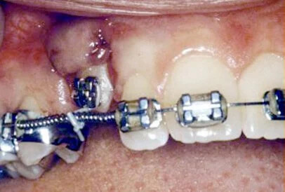 impacted tooth