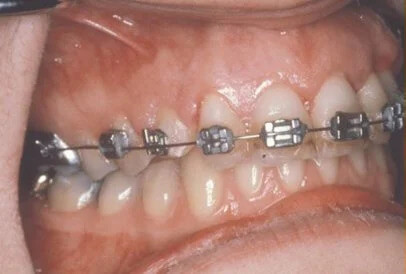 impacted tooth