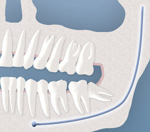 An example of a tooth with a partial bony impaction