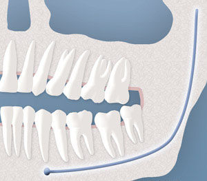 An representation of a tooth impacted by soft tissue