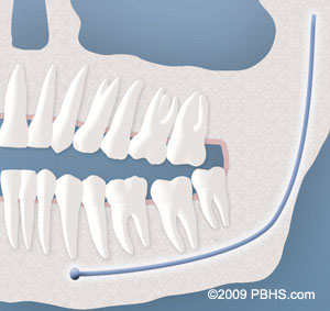 An representation of a tooth impacted by soft tissue